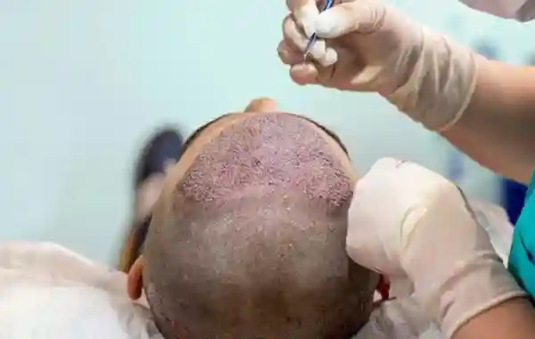 Bio Enhanced FUE Transplant