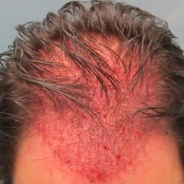 No Shave Hair Transplant