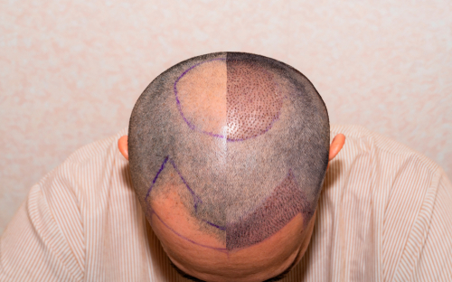 hair transplantation, hair transplants, hair transplantation dubai