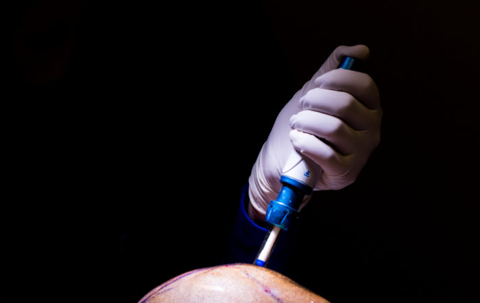 hair clinic dubai, hair transplant dubai, best hair transplant