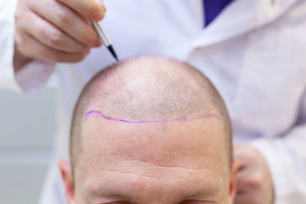 hair transplant abu dhabi, hair transplant clinic in abu dhabi, best hair transplant abu dhabi