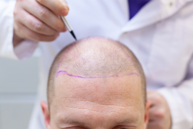 turkish hair transplant, turkish hair transplant dubai, hair transplant in dubai