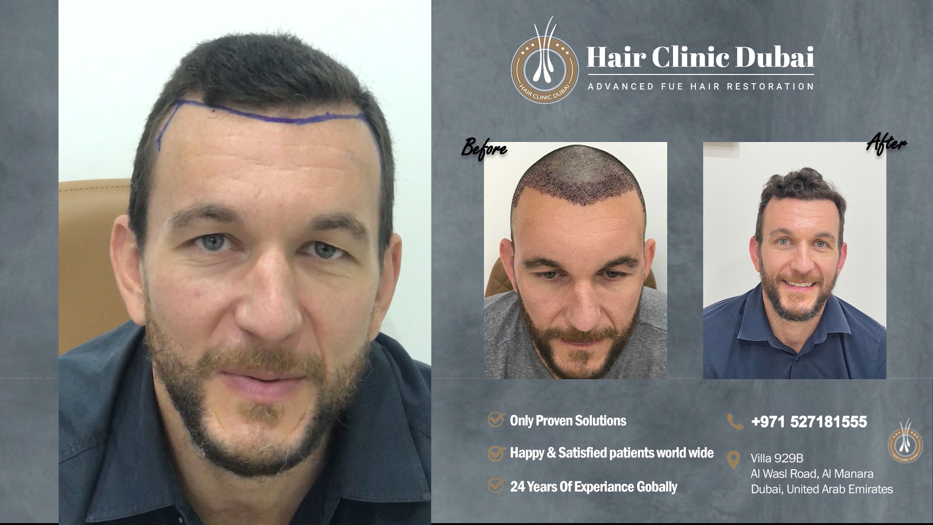 Hairline Transplant Dubai | Hair Replacement Dubai | Hair Clinic Dubai