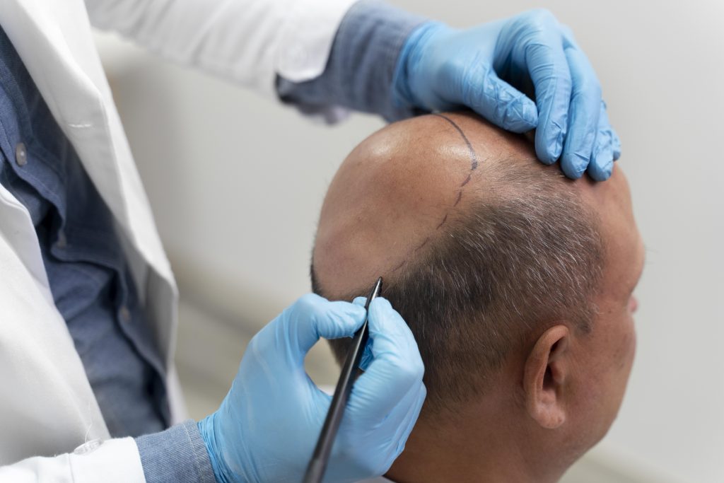 weak donor area and hair transplant