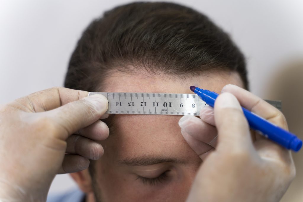 hair transplant for weak donor area