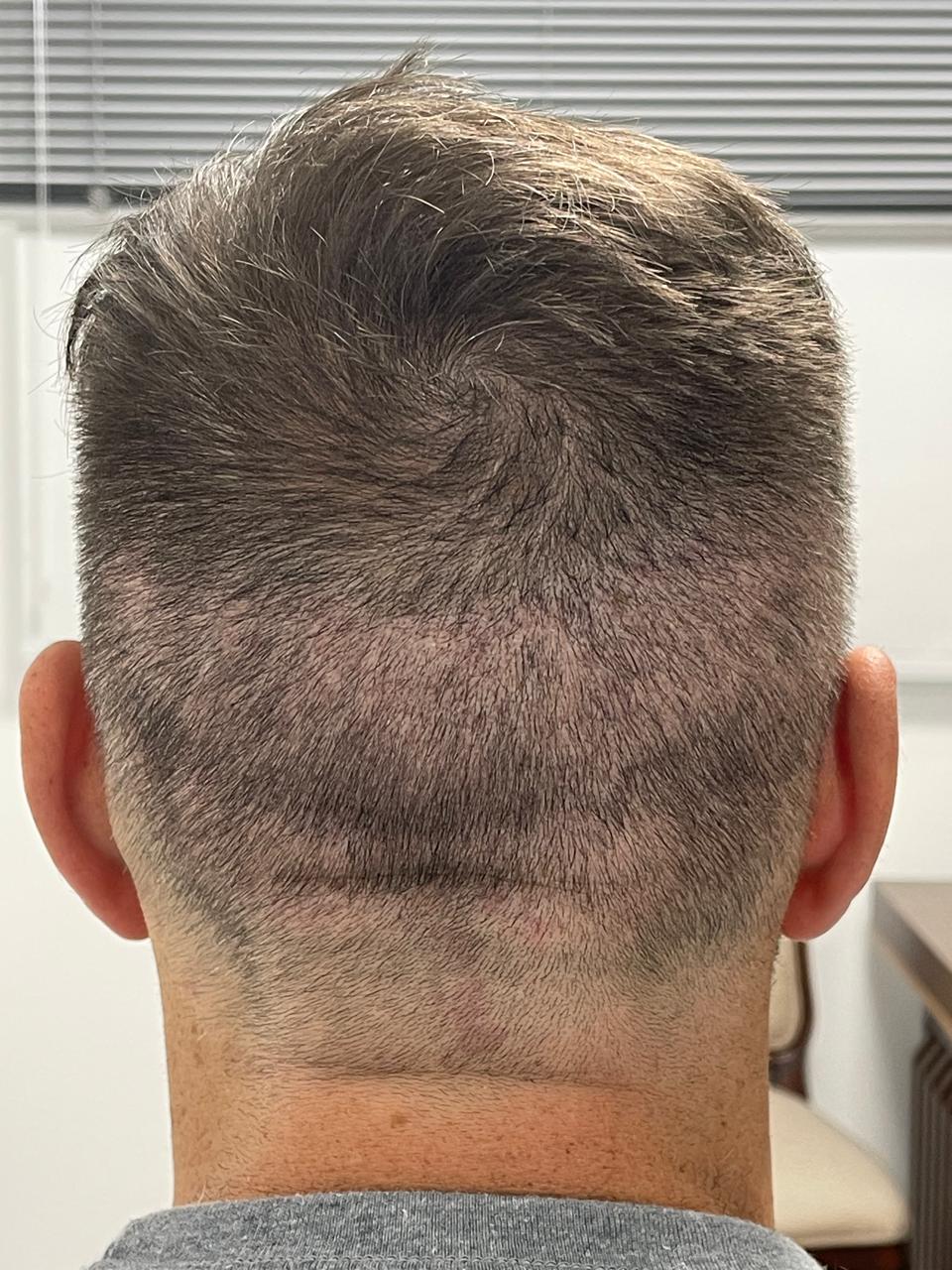 Natural Hairline Restoration