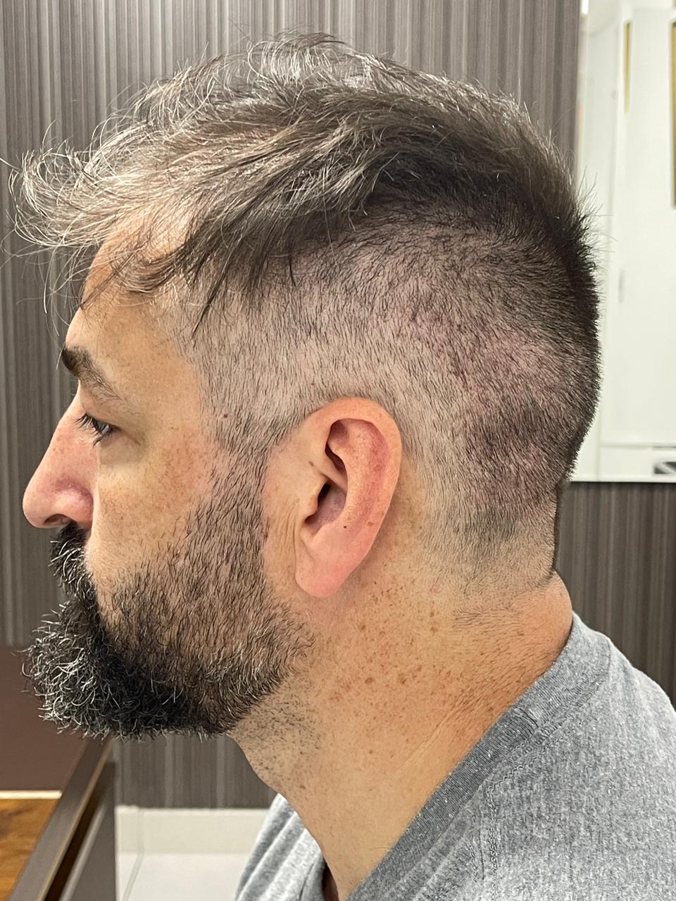 No Shave FUE Front View