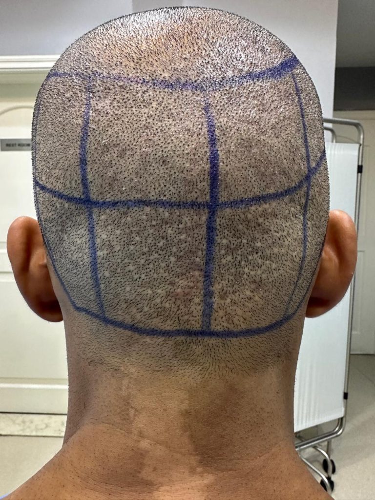 Back Donor Area Before Surgery