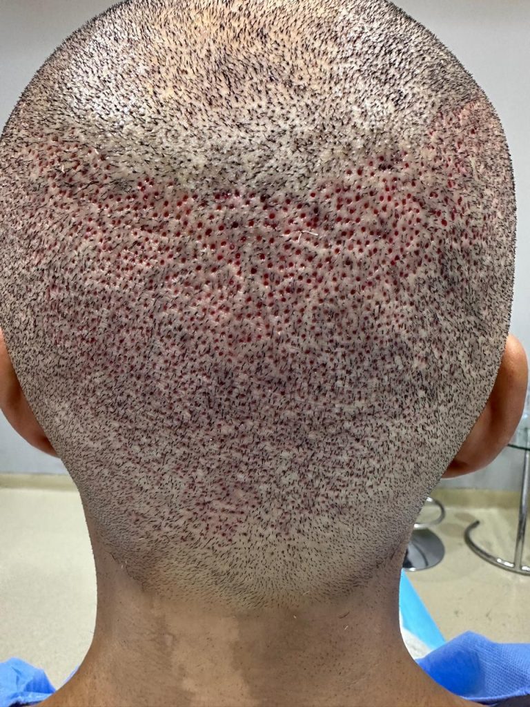 Immediately After Completion of African Hair Transplant Surgery