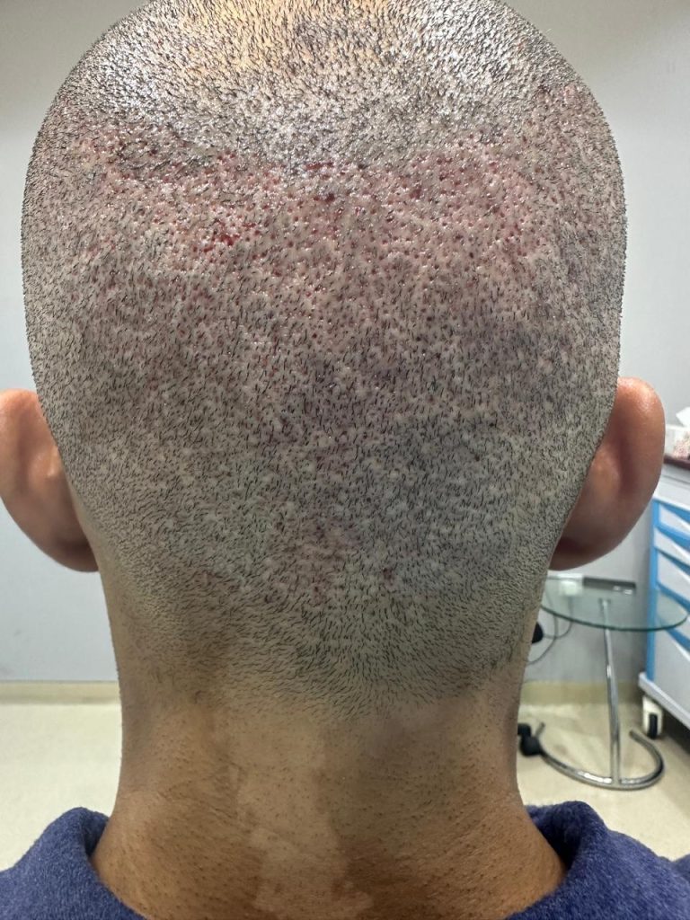 One Day After African Hair Transplant Surgery