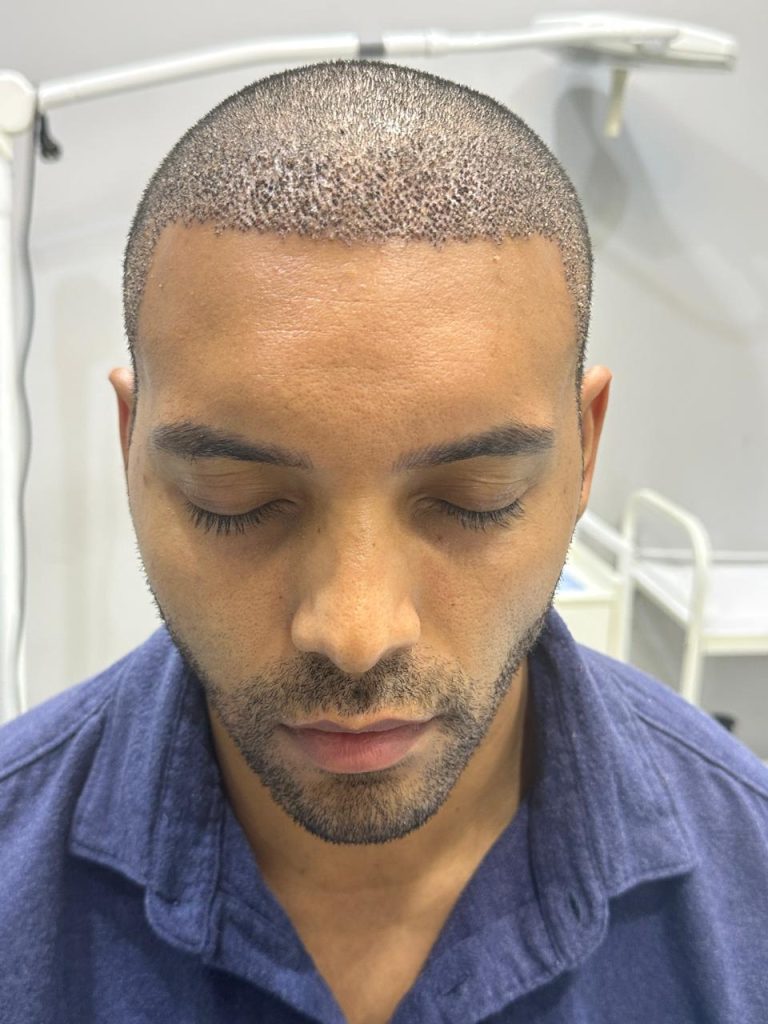 Four Days After Surgery – Normal Healing Progress
