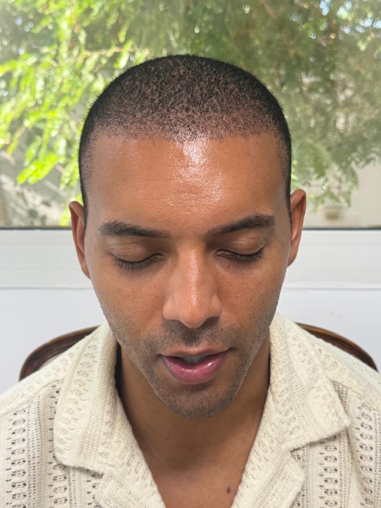 10–12 Days After African Hair Transplant