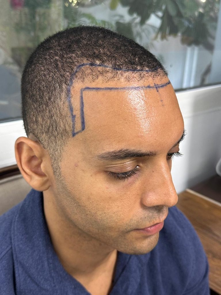 Before the Procedure – Initial Consultation and Hair Assessment
