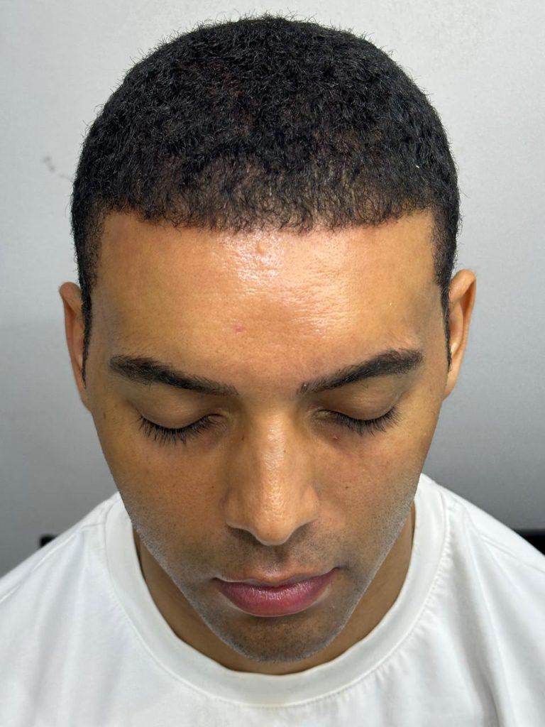 5–6 Months After African Hair Transplant – Visible Hair Growth
