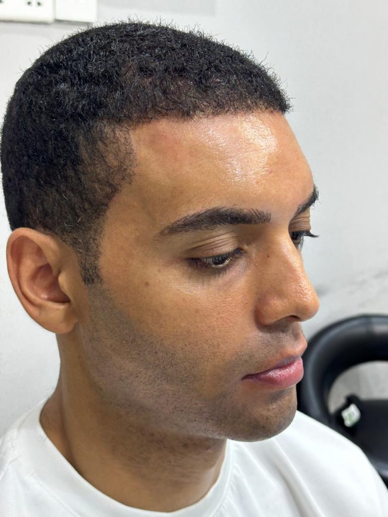 5–6 Months After African Hair Transplant – Visible Hair Growth