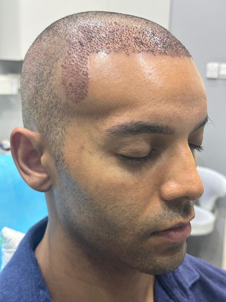 One Day After African Hair Transplant Surgery