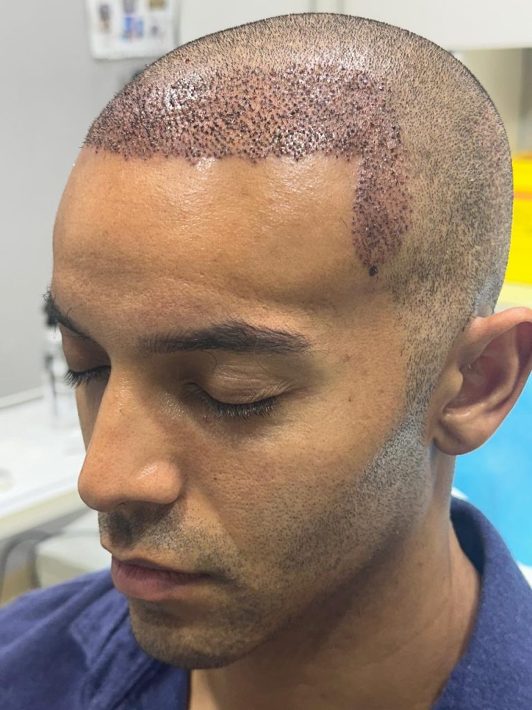 One Day After African Hair Transplant Surgery