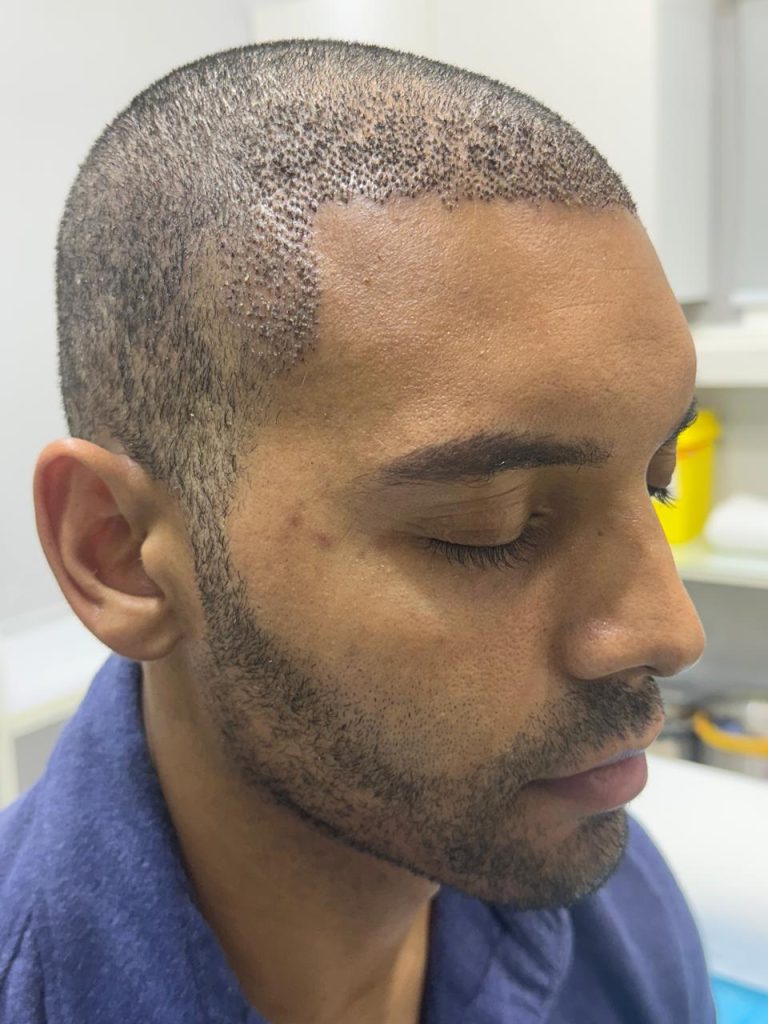 Four Days After Surgery – Normal Healing Progress