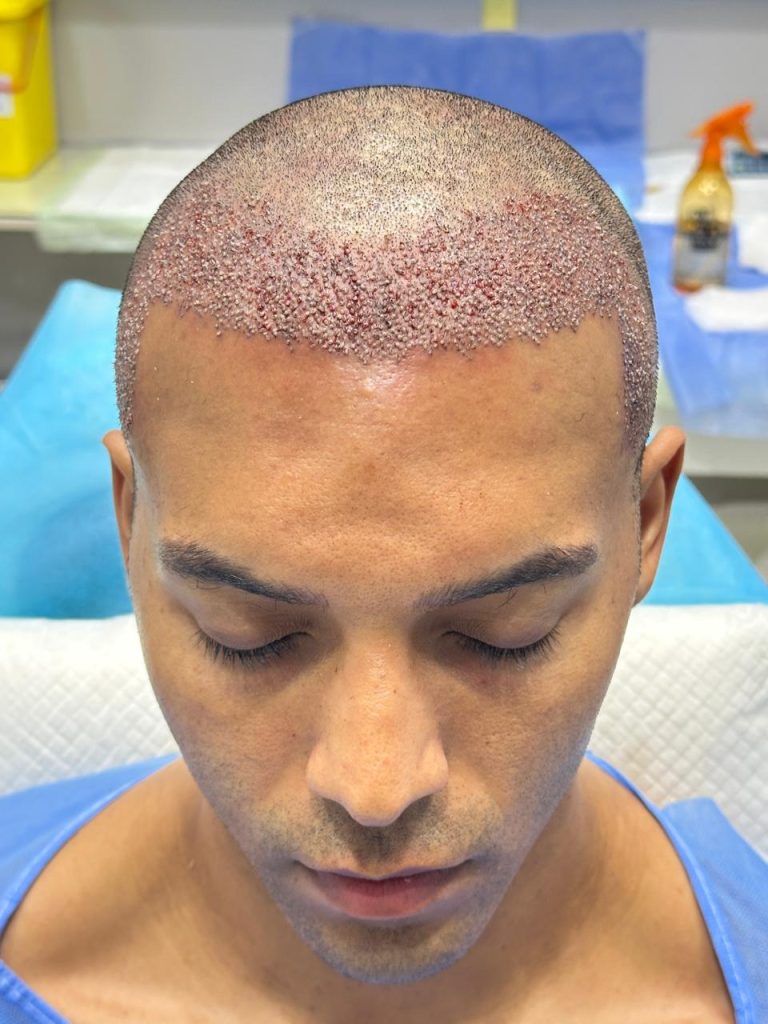 Immediately After Completion of African Hair Transplant Surgery