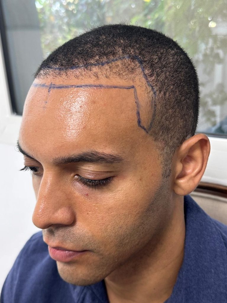 Before the Procedure – Initial Consultation and Hair Assessment