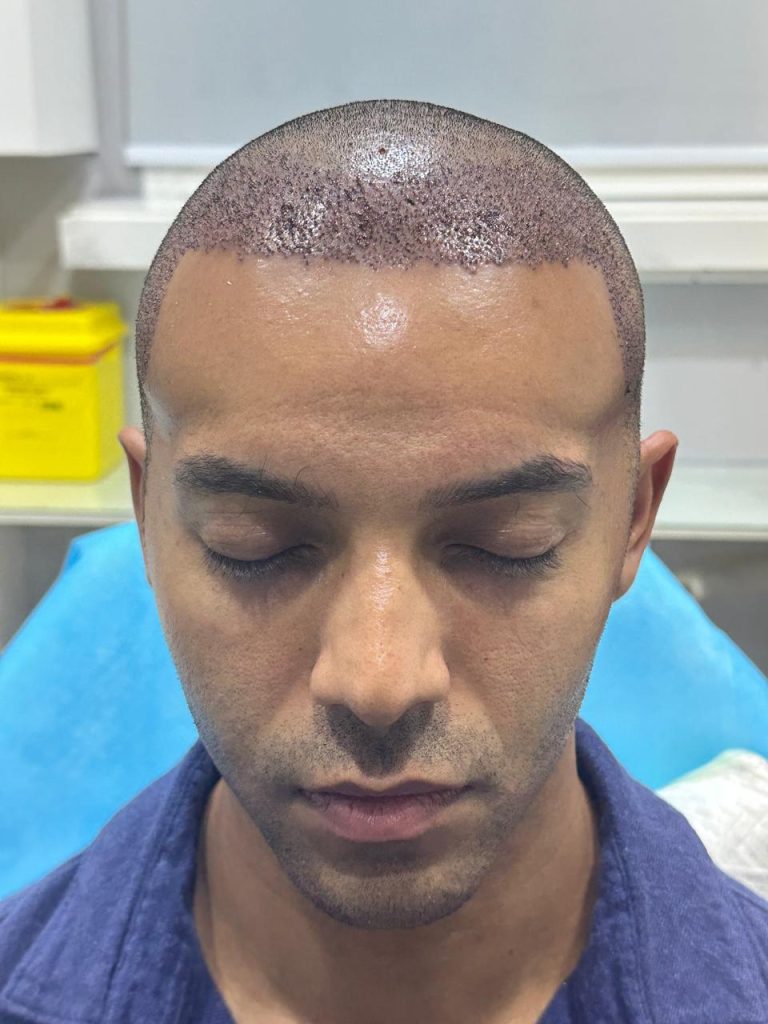One Day After African Hair Transplant Surgery