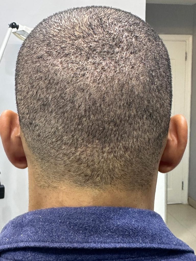 Four Days After Surgery – Normal Healing Progress