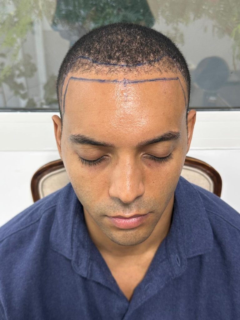 Before the Procedure – Initial Consultation and Hair Assessment