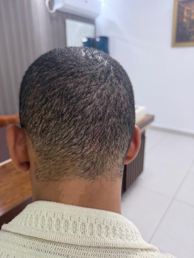 10–12 Days After African Hair Transplant