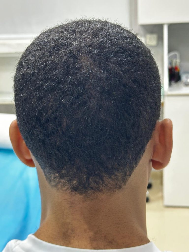 5–6 Months After African Hair Transplant – Visible Hair Growth