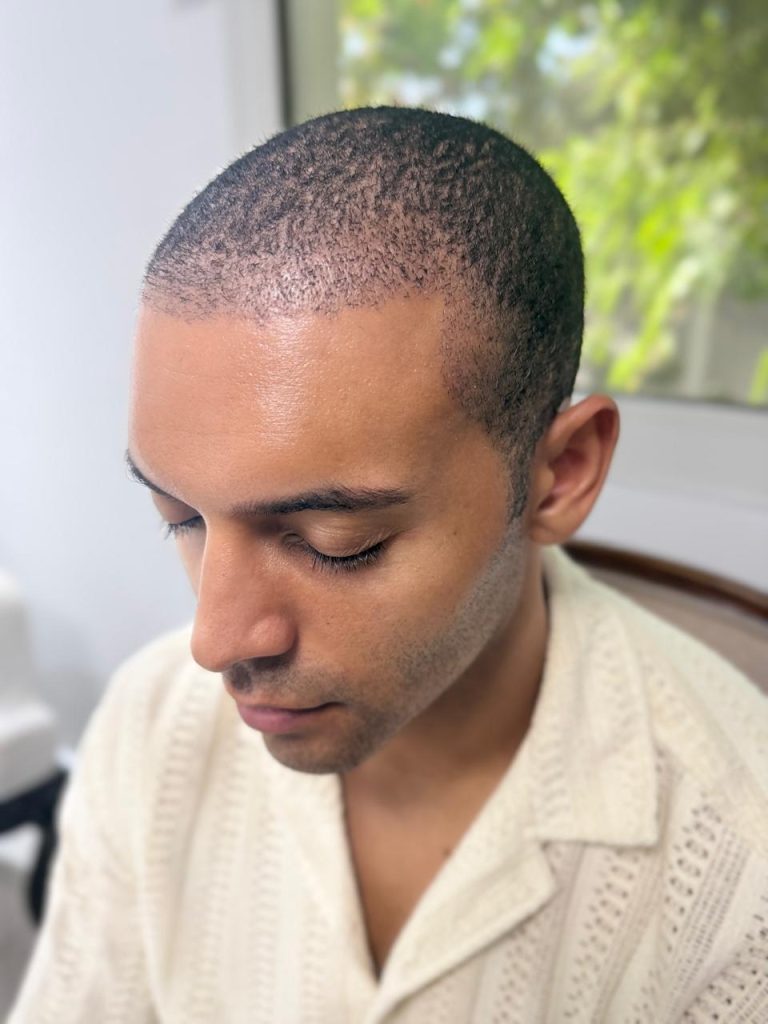 10–12 Days After African Hair Transplant