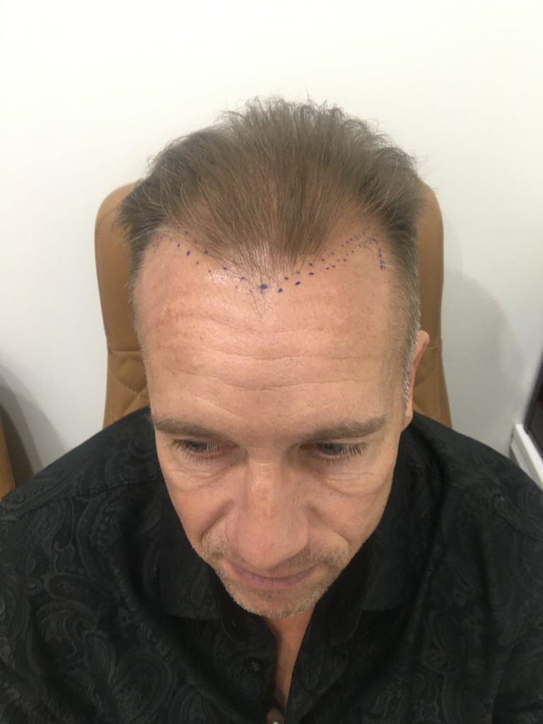 Before Hair Transplant – Mr. Jean-Paul Courville | Hair Clinic Dubai