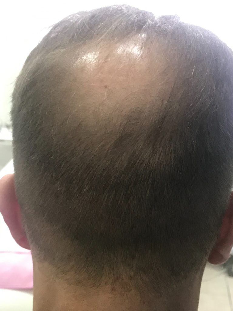 Before Hair Transplant – Mr. Jean-Paul Courville | Hair Clinic Dubai