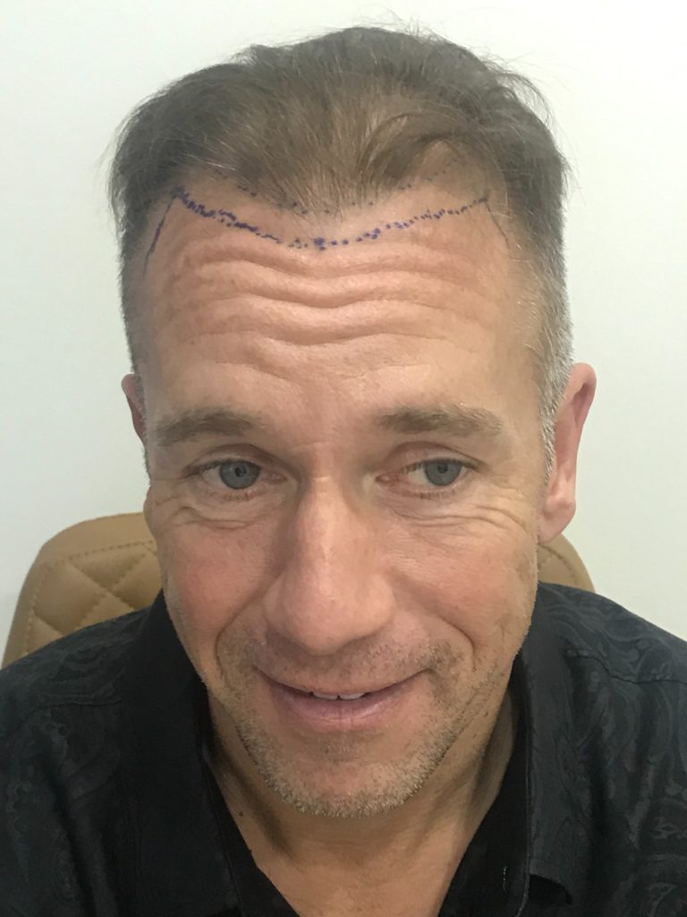 Before Hair Transplant – Mr. Jean-Paul Courville | Hair Clinic Dubai