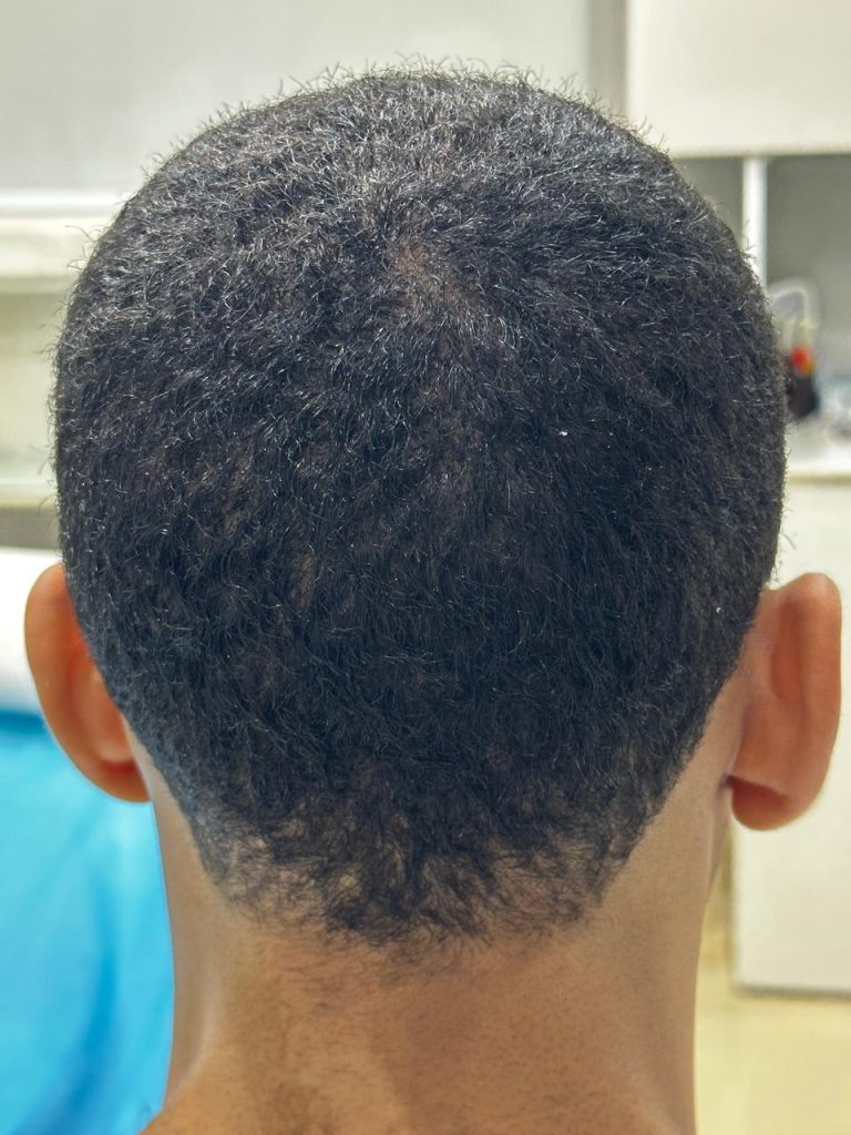 5–6 Months After African Hair Transplant – Visible Hair Growth