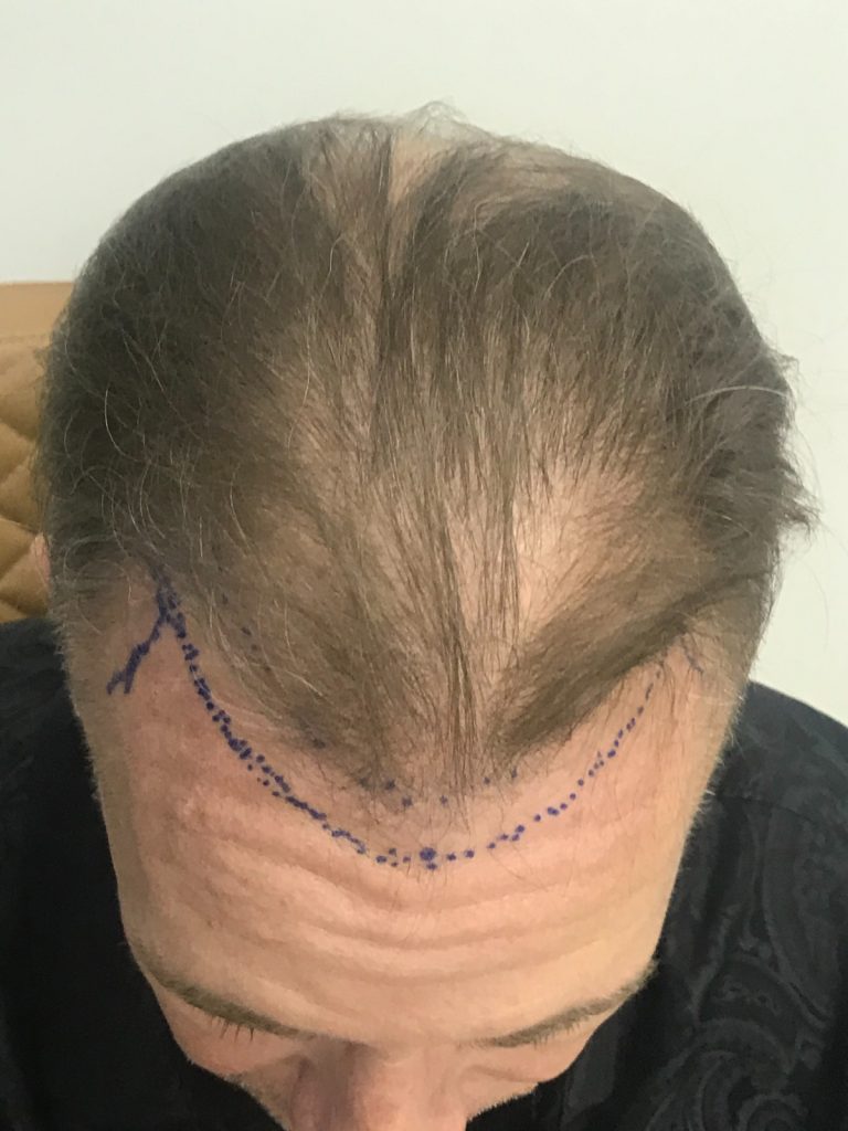 Before Hair Transplant – Mr. Jean-Paul Courville | Hair Clinic Dubai