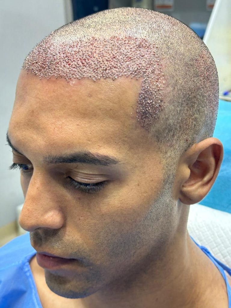 Immediately After Completion of African Hair Transplant Surgery