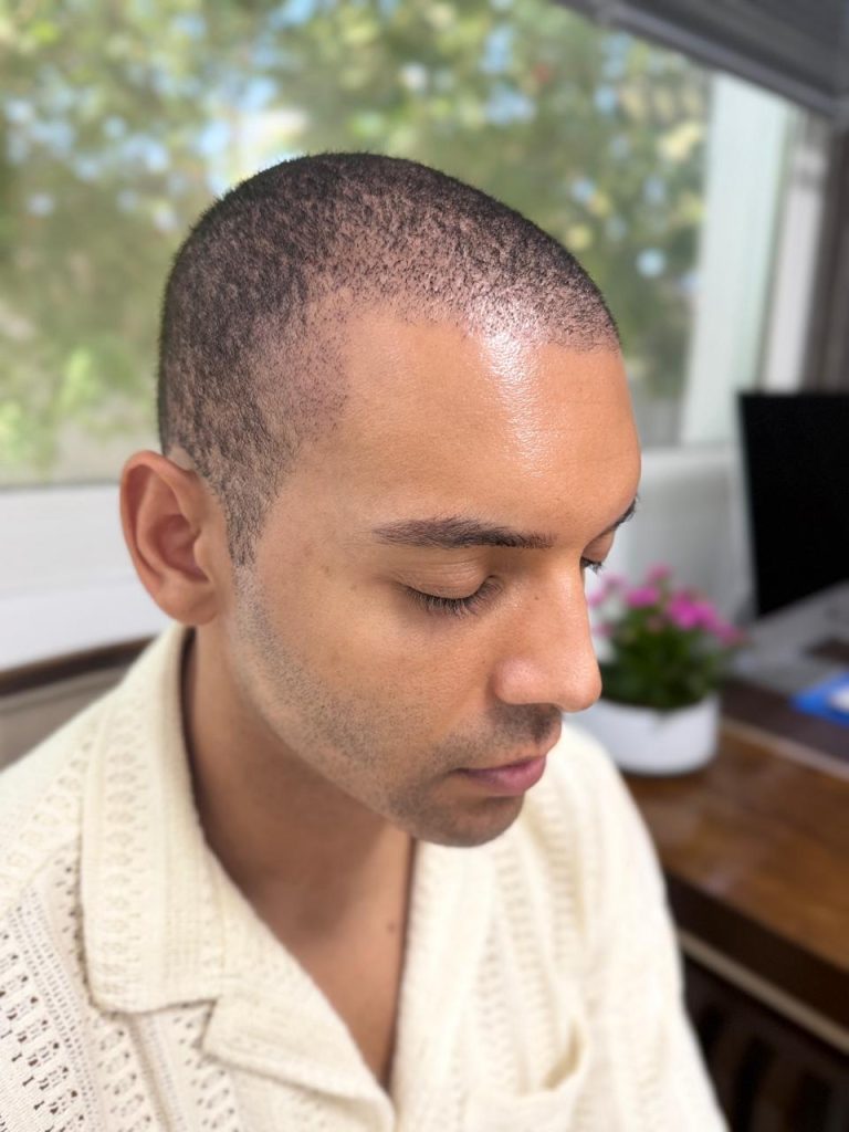 10–12 Days After African Hair Transplant