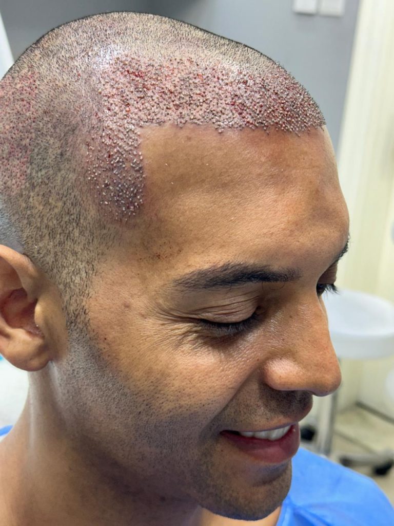 Immediately After Completion of African Hair Transplant Surgery