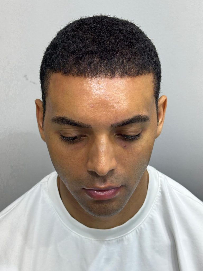 5–6 Months After African Hair Transplant – Visible Hair Growth