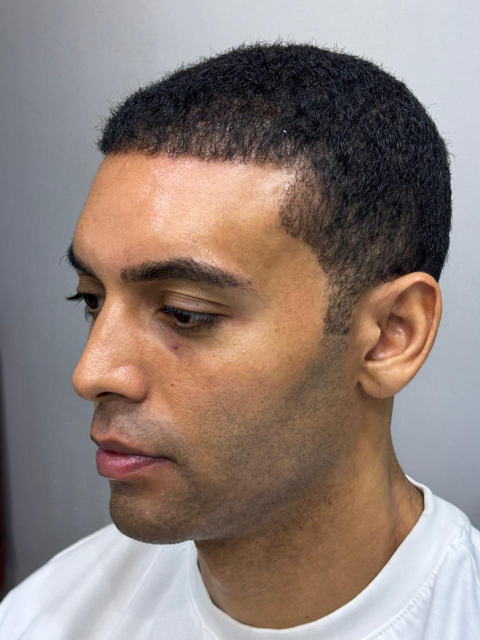 5–6 Months After African Hair Transplant – Visible Hair Growth