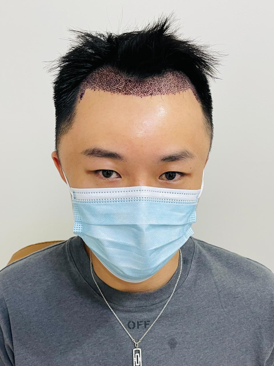 Bio-Enhanced FUE 3