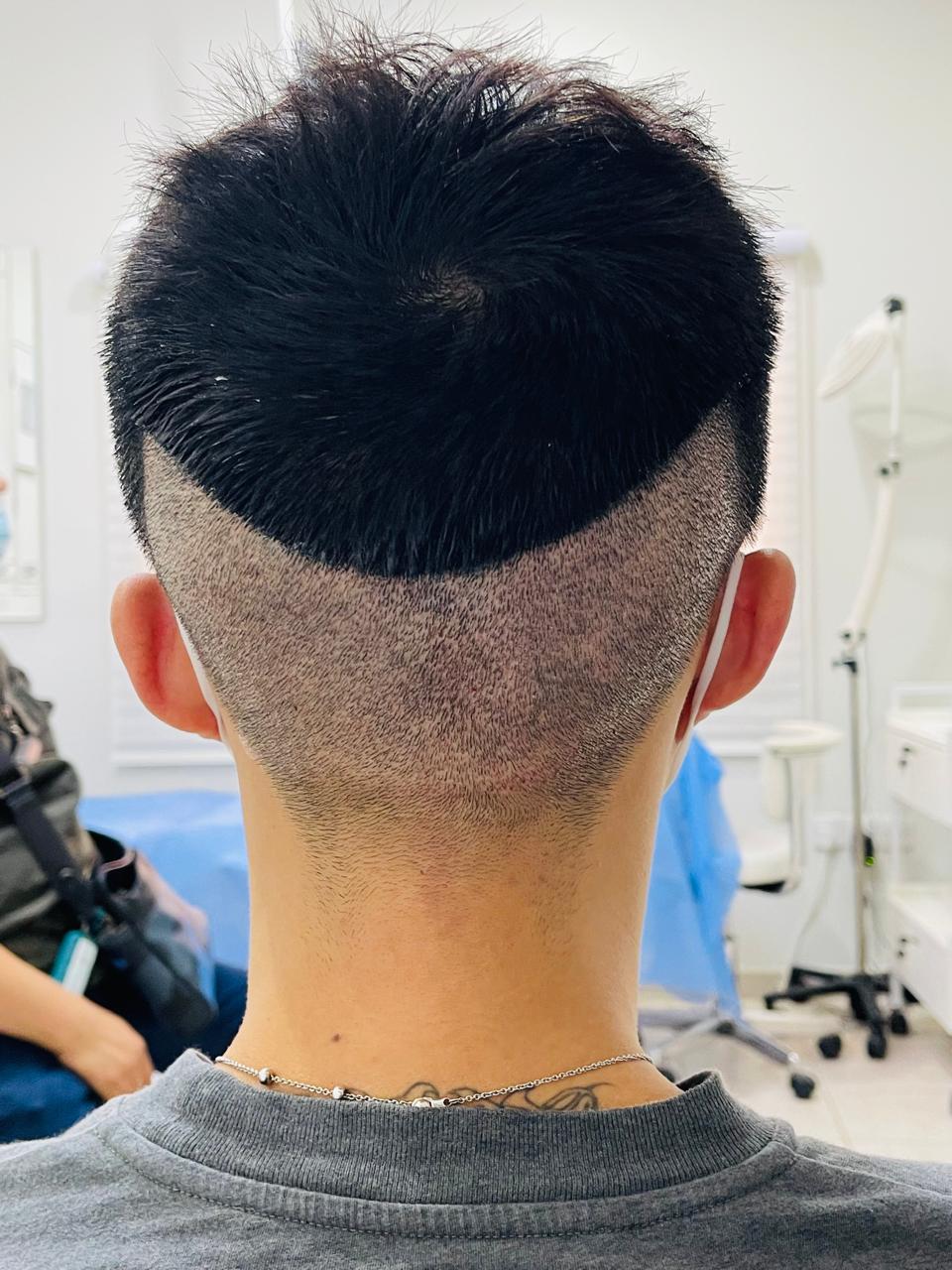 Bio-Enhanced FUE 3