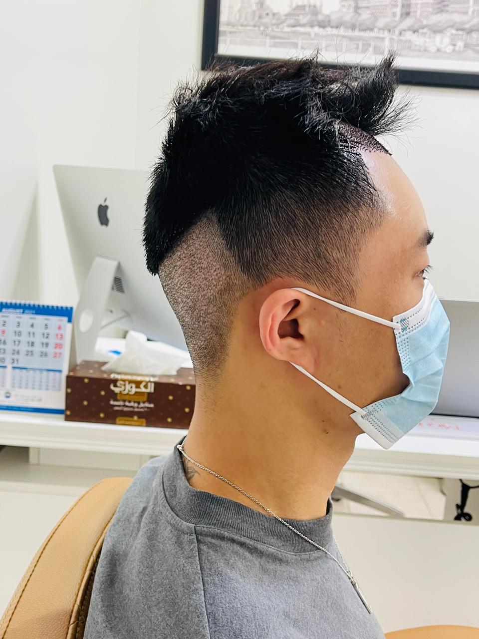 Bio-Enhanced FUE 3