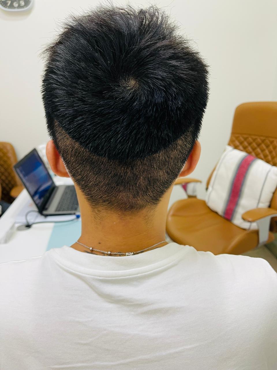 Bio-Enhanced FUE 3