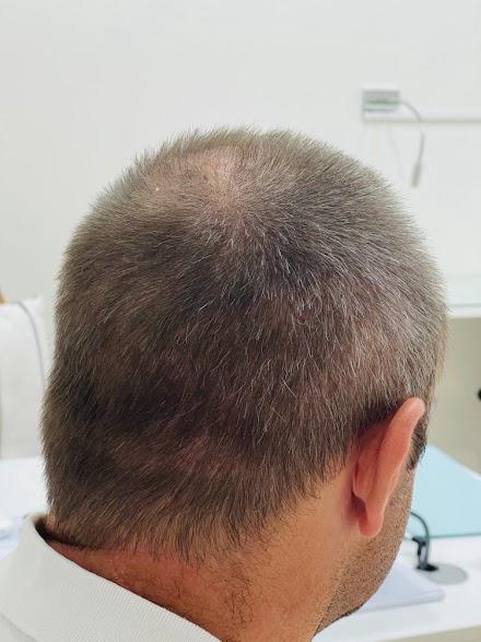 Bio-Enhanced FUE 3