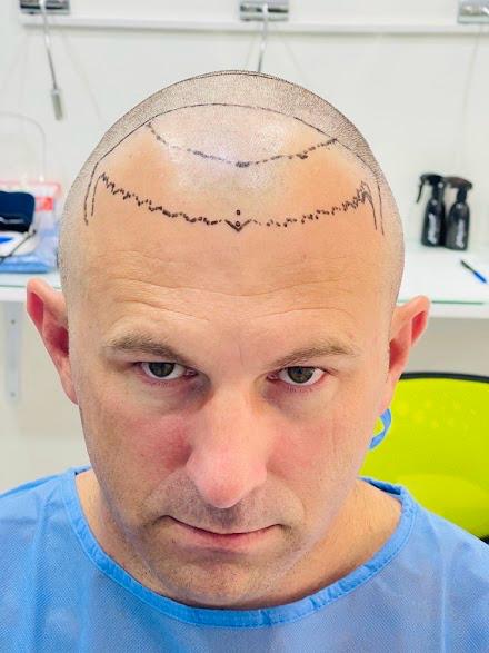 Bio-Enhanced FUE 3