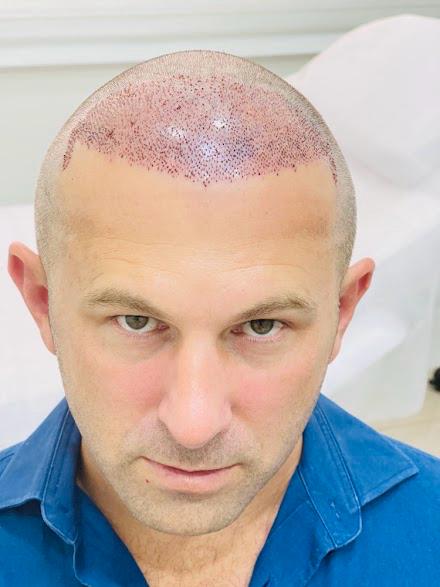 Bio-Enhanced FUE 3