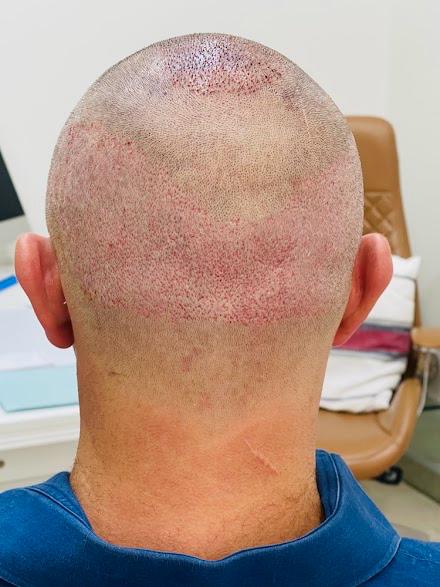 Bio-Enhanced FUE 3