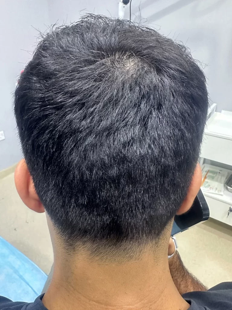 Hair Transplant After 4 Days