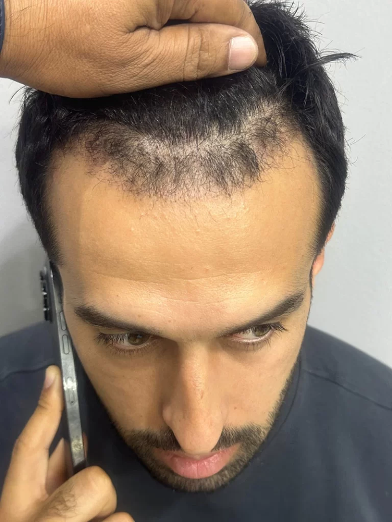 Hair Transplant After 4 Weeks